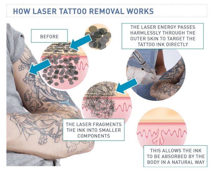 skematisk oversigt over en tatoverings placering i huden