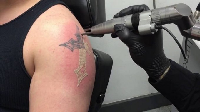 Tatoveringsfjernelse - 2