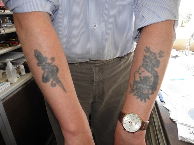 Mine tatoveringer, nu skal de fjernes